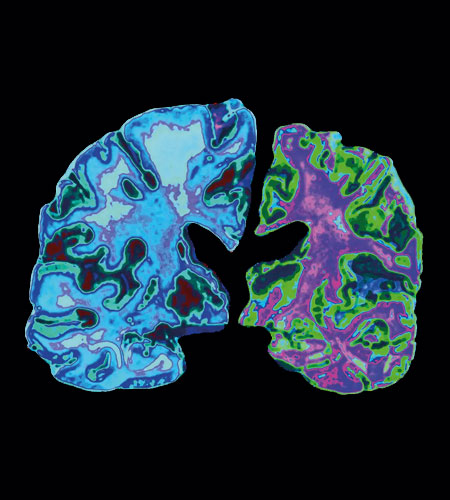 Alzheimers Disease treatment in Narasaraopet